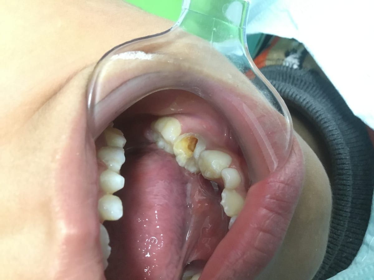 后牙树脂充填案例影像