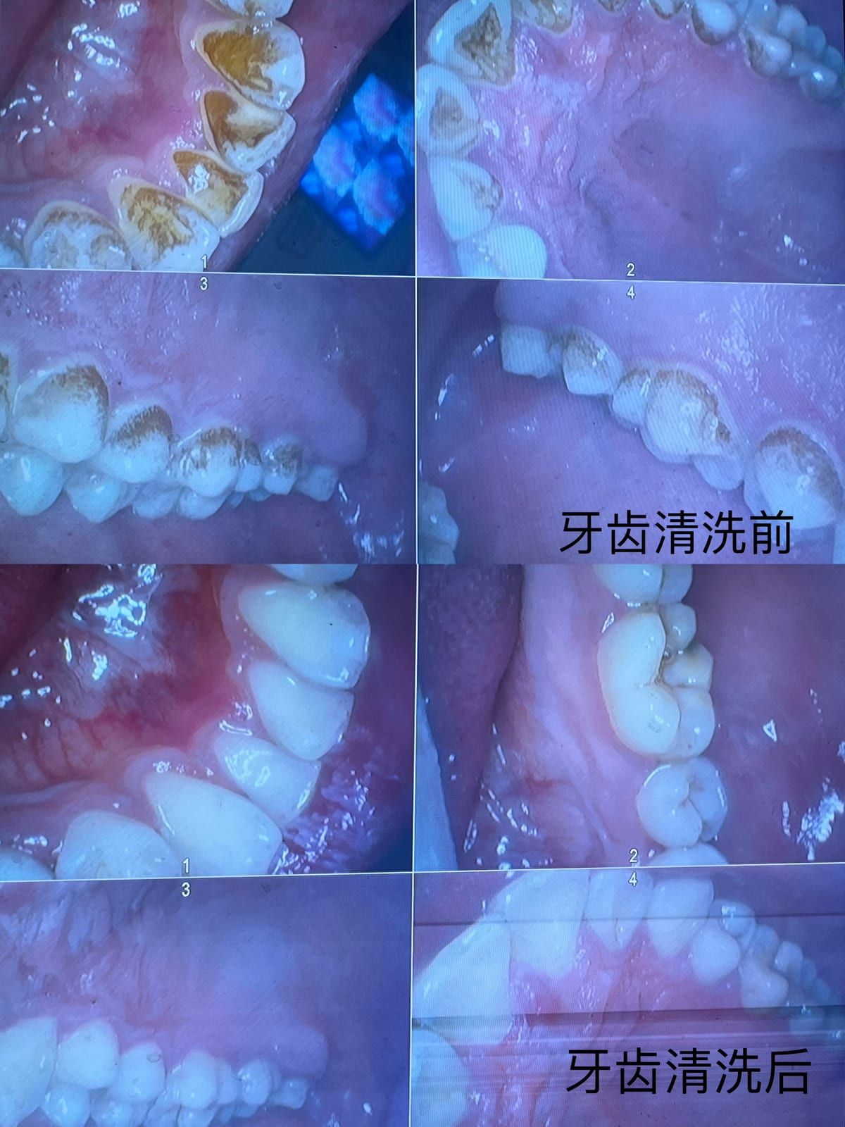 烟渍洁牙案例影像
