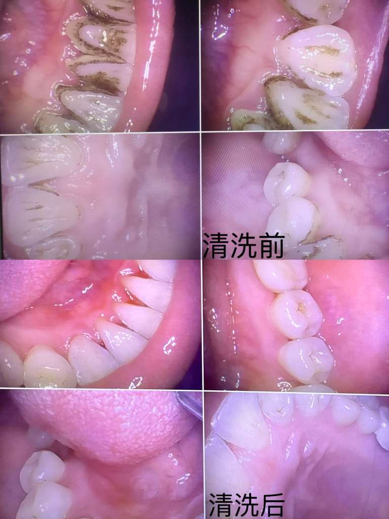 常规洁牙案例影像